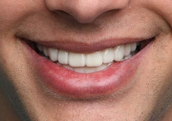 A1 - Pure Natural White light skin example