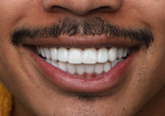 A1 - Pure Natural White medium skin example