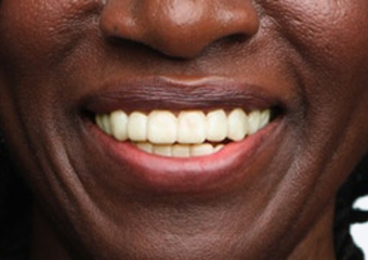 A2 - Light Ivory dark skin example