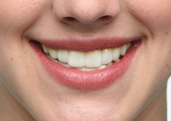 A2 - Light Ivory fair skin example