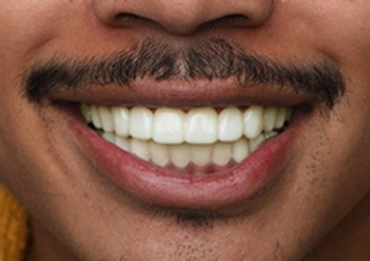 A3 - Medium Ivory medium skin example