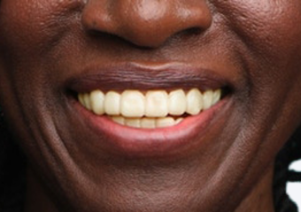A3 - Medium Ivory dark skin example