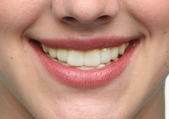 A3 - Medium Ivory fair skin example