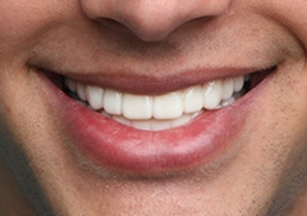 BL1 - Hollywood White light skin example