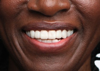 BL1 - Hollywood White dark skin example