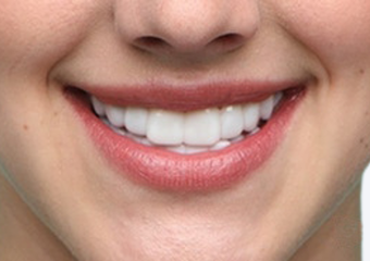 BL1 - Hollywood White fair skin example